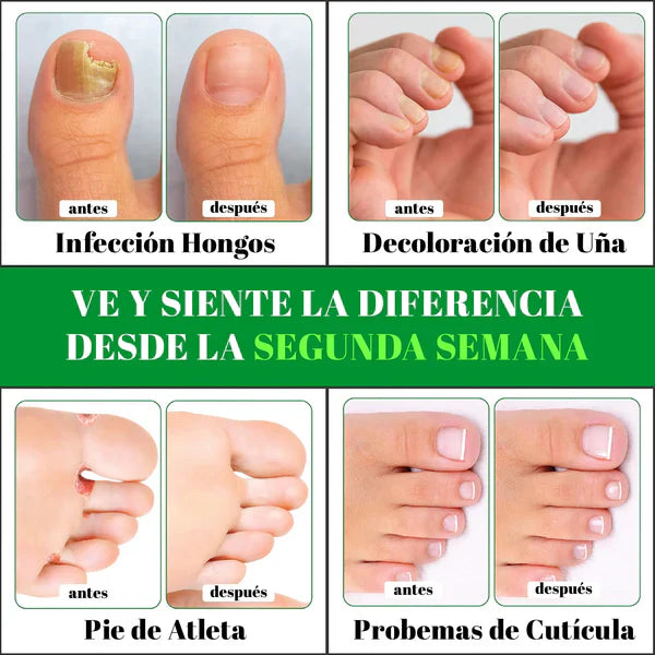 GOTAS ANTIMICOTICAS ELIMINA HONGOS (PIES Y MANOS )