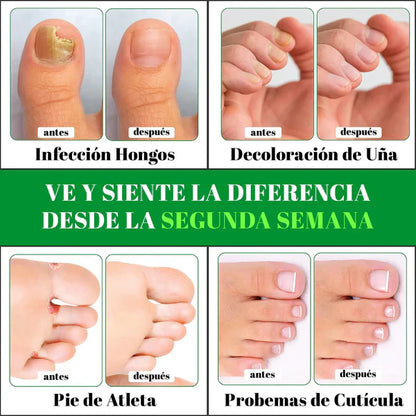 GOTAS ANTIMICOTICAS ELIMINA HONGOS (PIES Y MANOS )